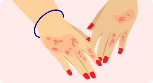 allergic on someones hands